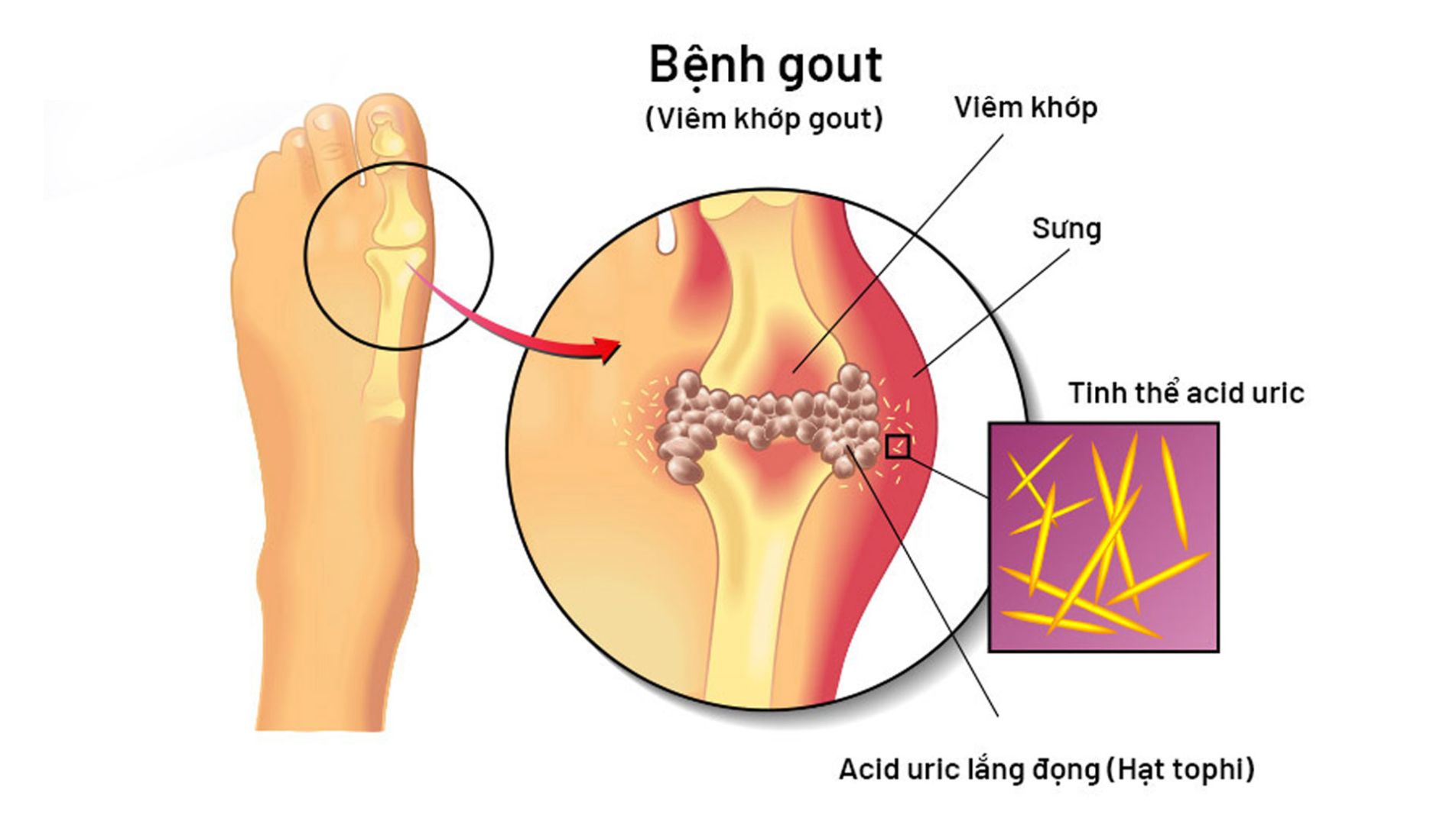 Nguyên nhân bệnh gút: tăng acid uric và lắng đọng tinh thể urat