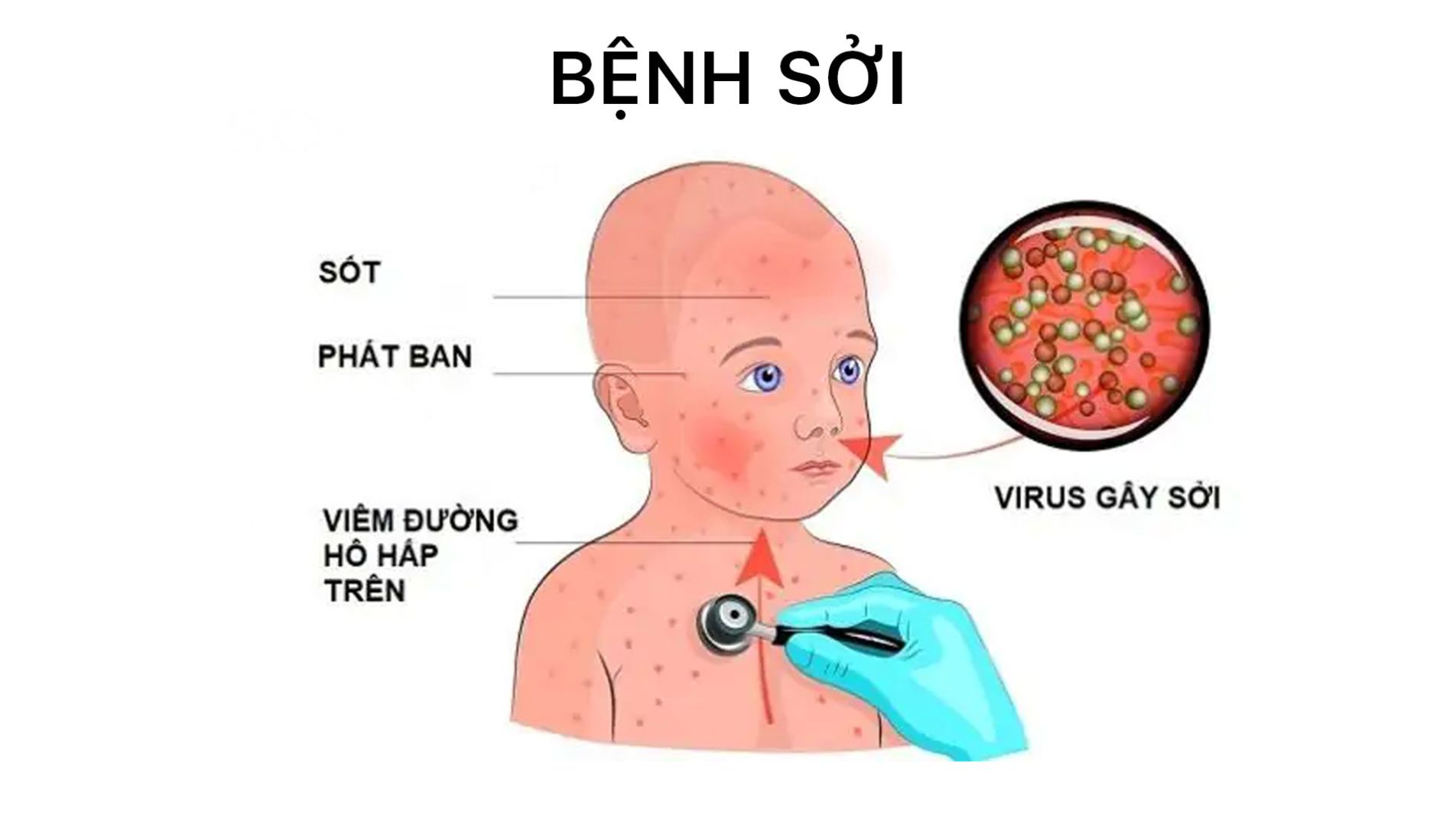 Cách lây truyền bệnh sởi qua đường hô hấp