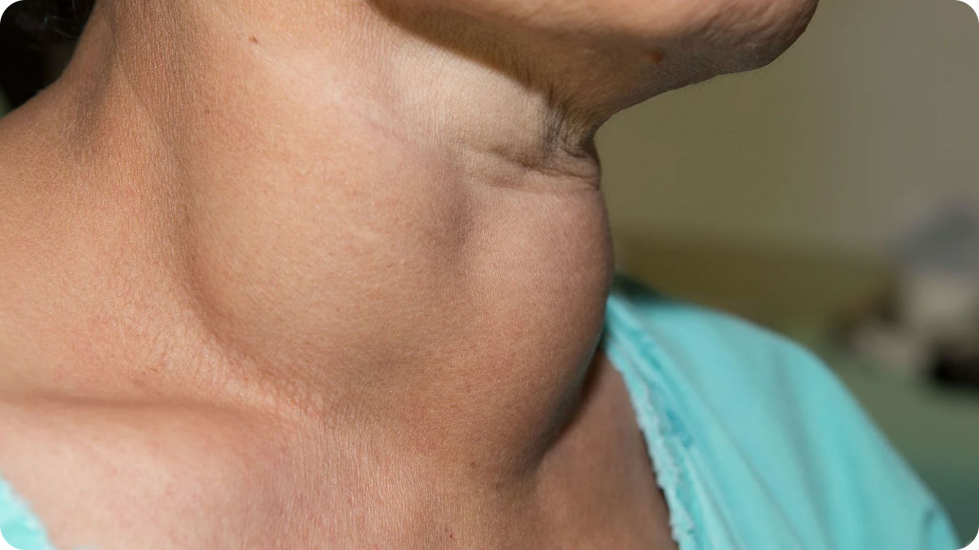 Hình ảnh triệu chứng sưng cổ trong bướu cổ (goiter).