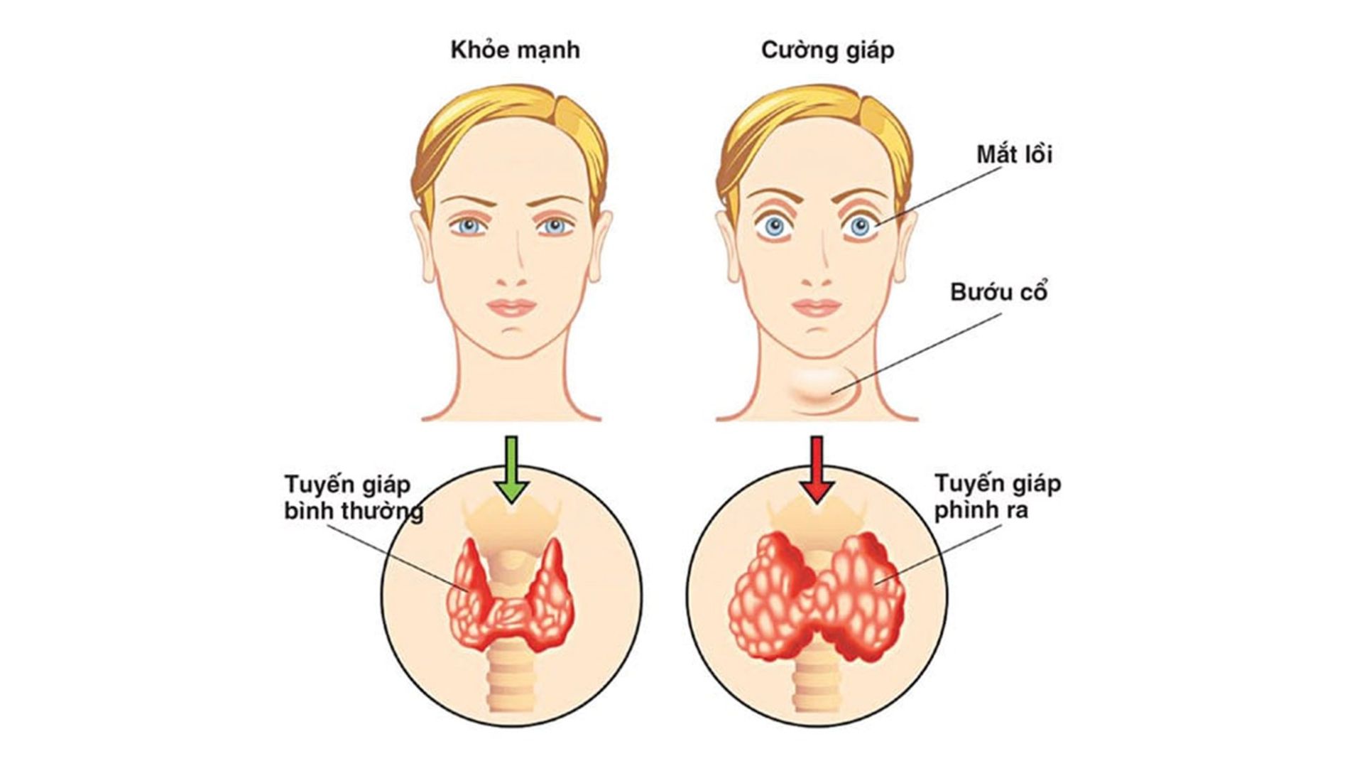 Sơ đồ tuyến giáp và nguyên nhân gây bướu cổ.