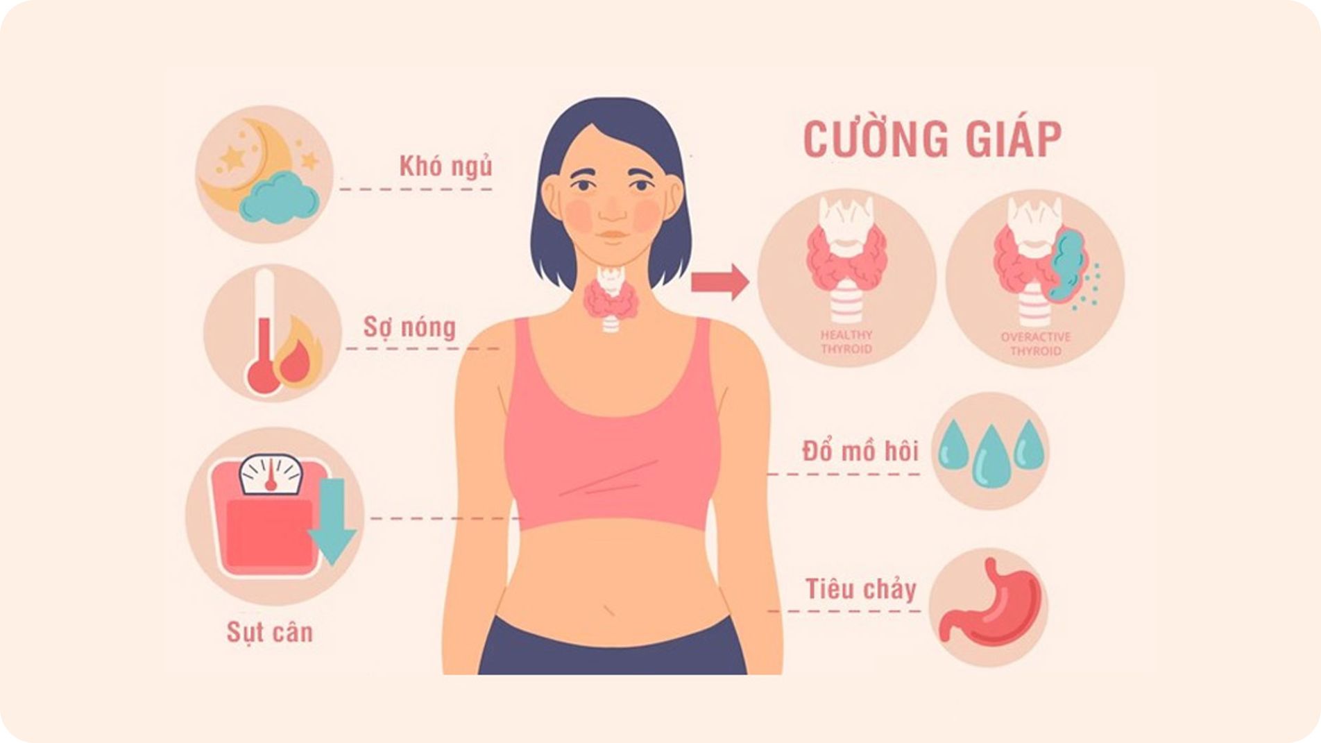 Triệu chứng phổ biến của cường giáp như run tay và sụt cân