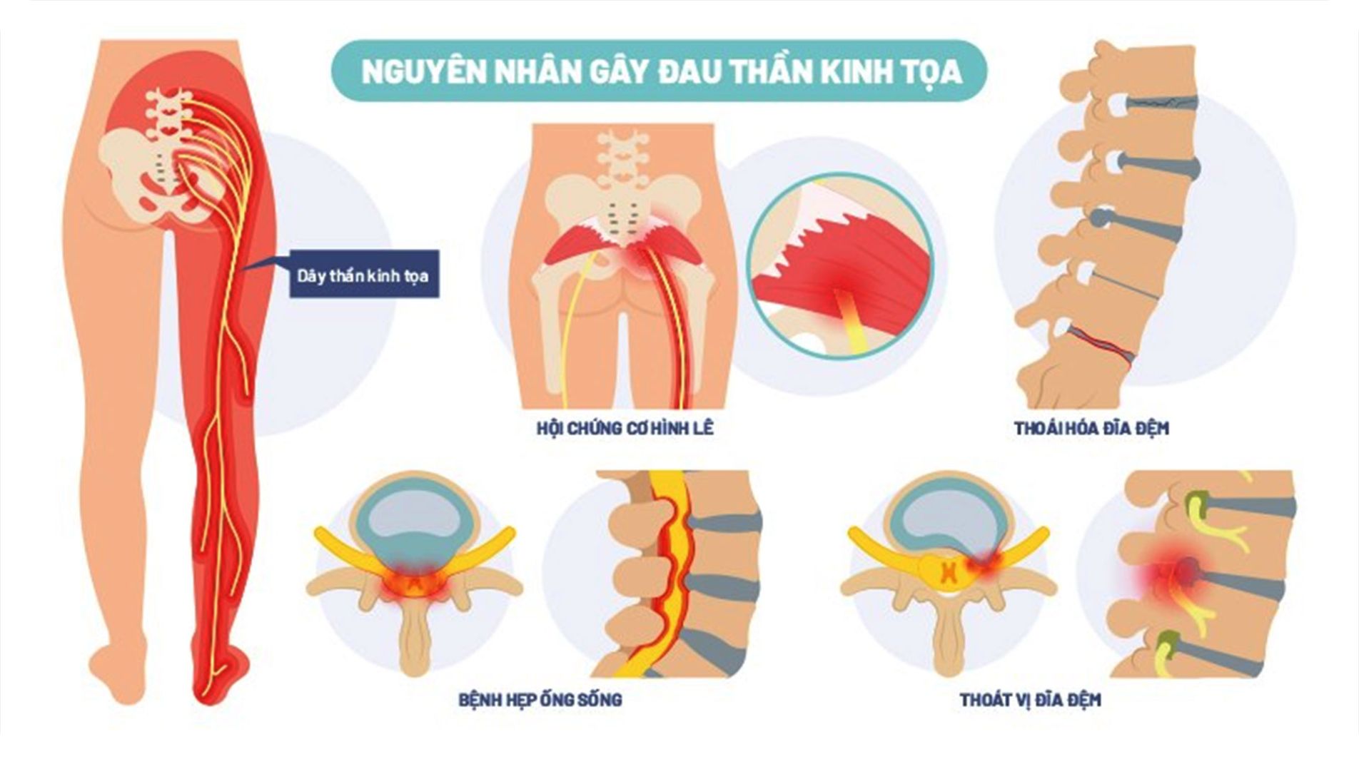 Sơ đồ đường đi dây thần kinh tọa và vùng đau điển hình