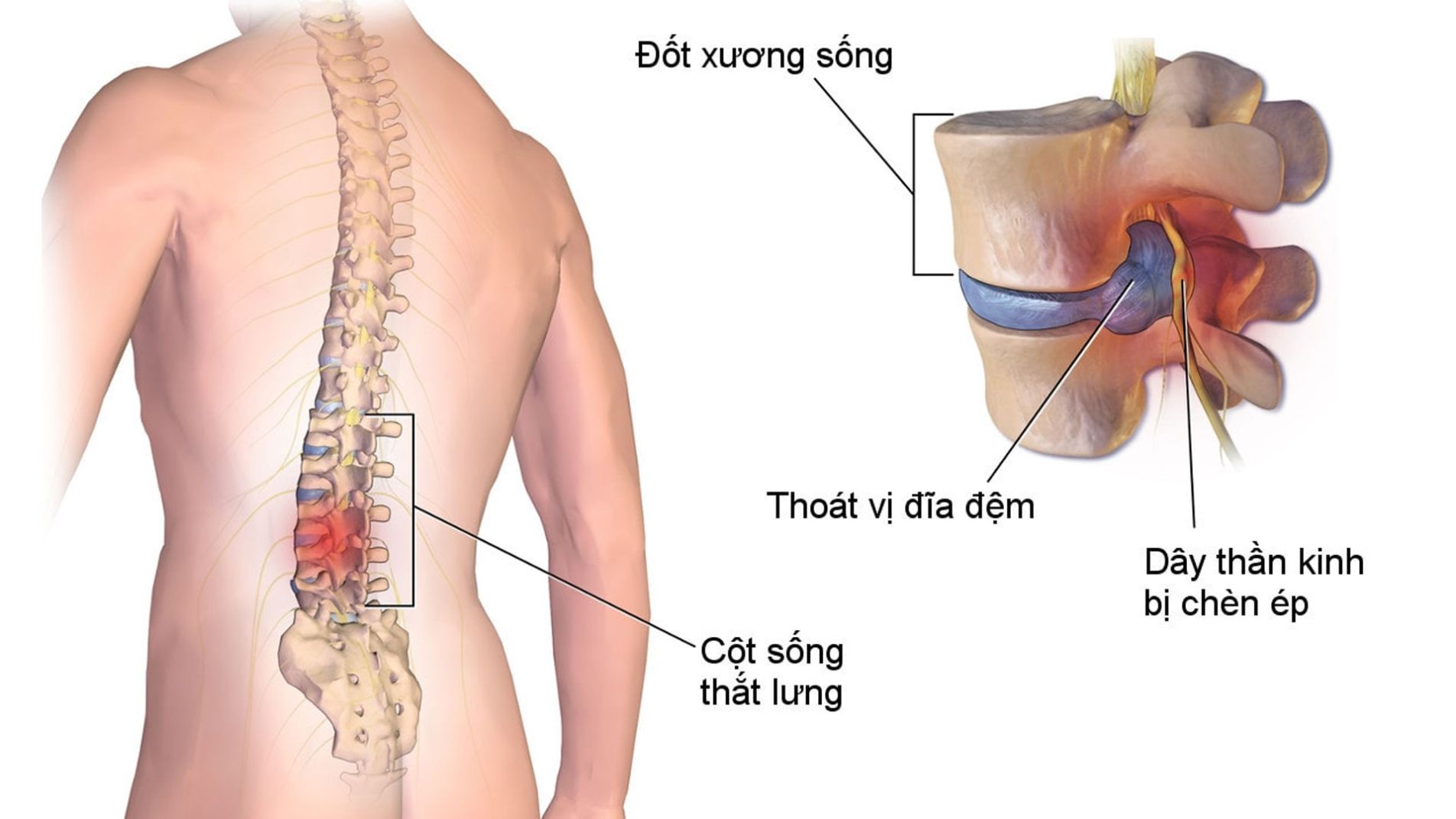 Thoát vị đĩa đệm gây chèn ép dây thần kinh tọa