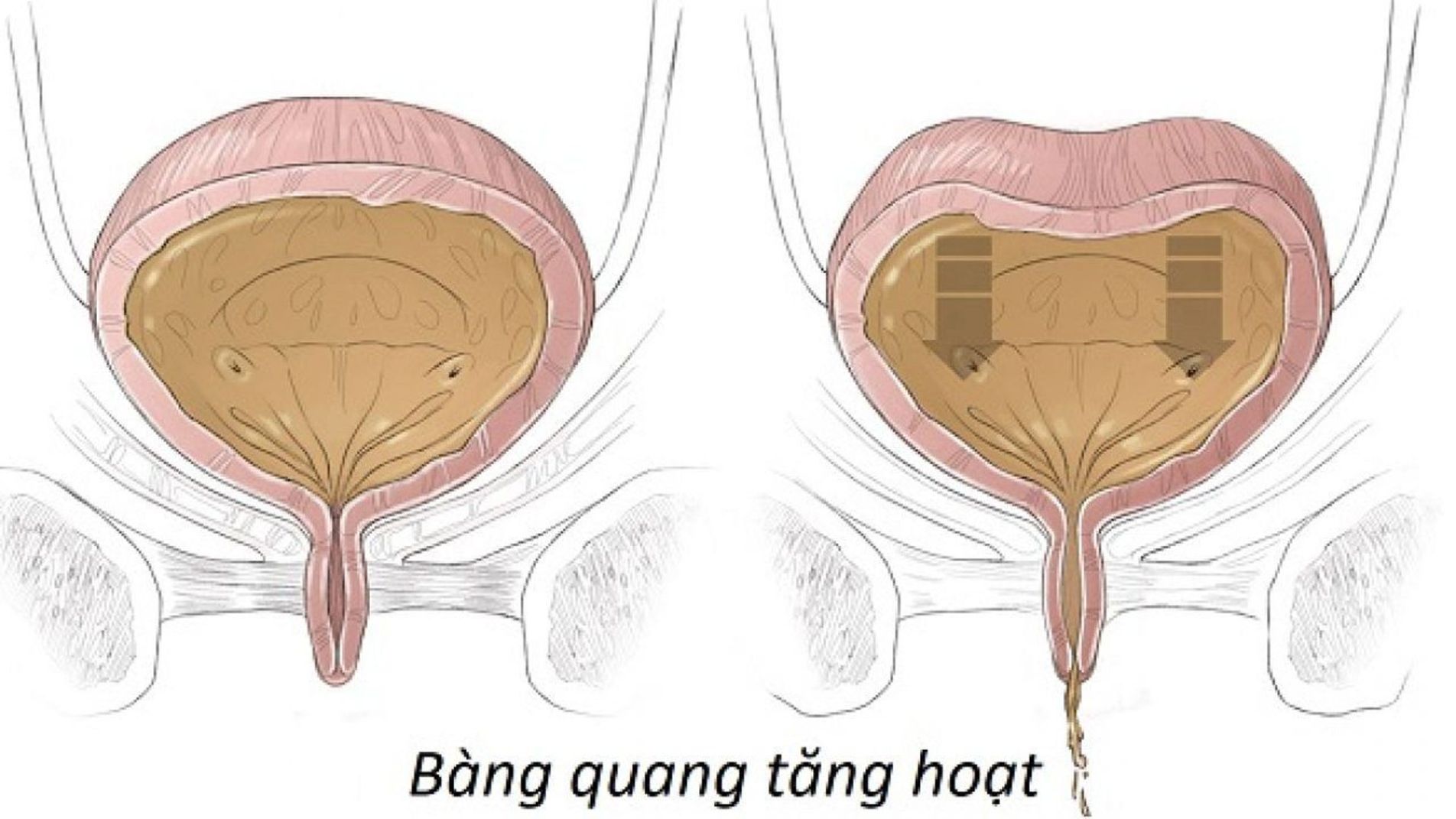 bàng quang tăng hoạt gây đi tiểu nhiều lần