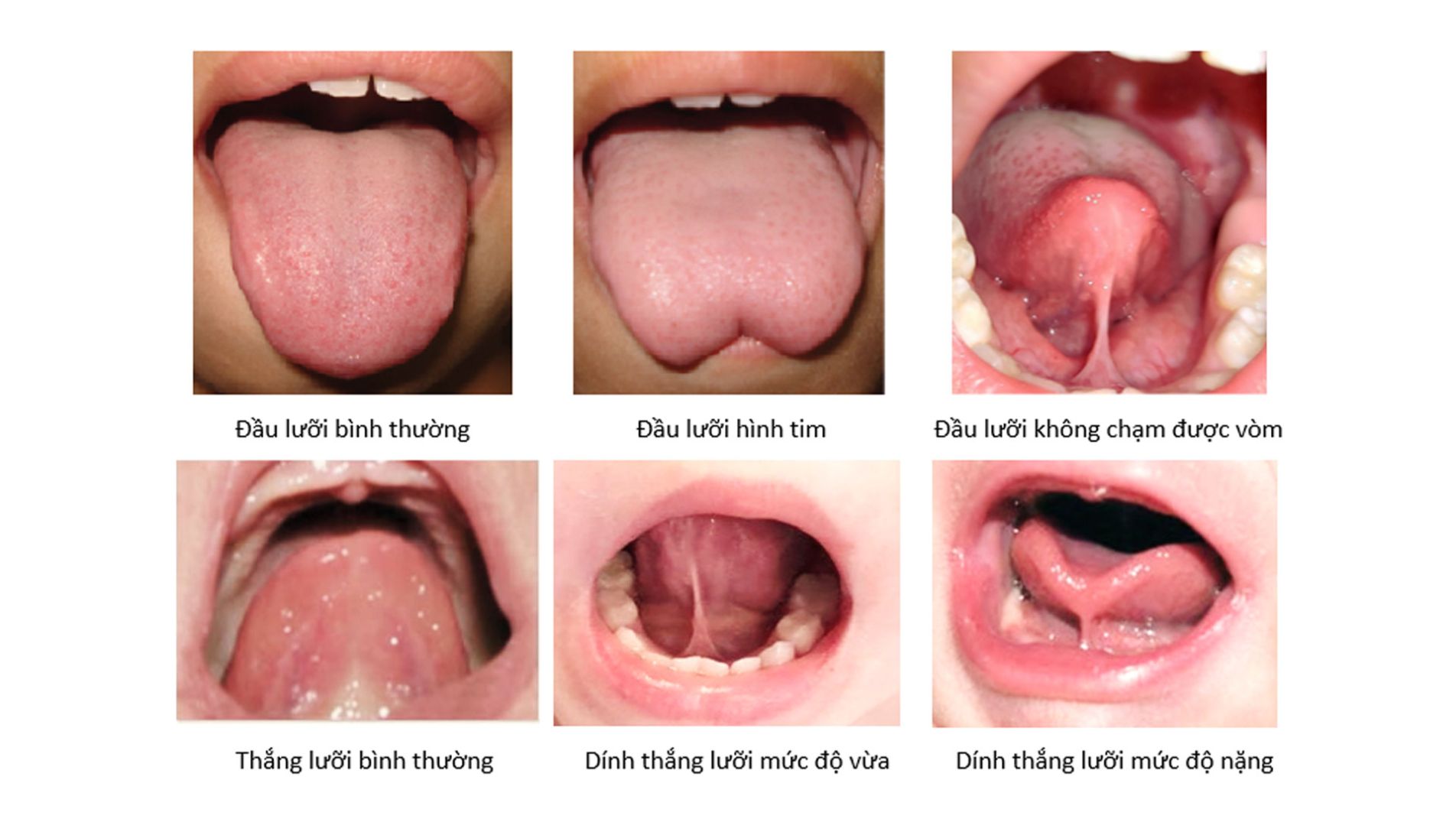 Dấu hiệu dính thắng lưỡi ở trẻ em với lưỡi hình trái tim