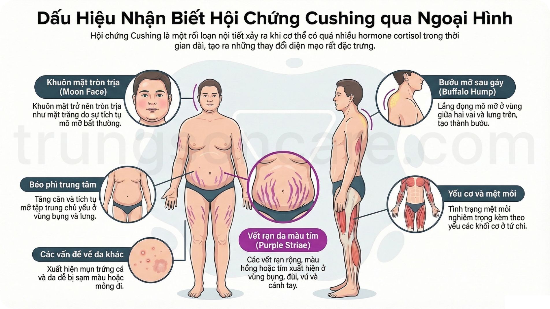 các dấu hiệu ngoại hình điển hình của hội chứng Cushing: mặt tròn, bướu mỡ sau gáy, vết rạn da bụng màu tím
