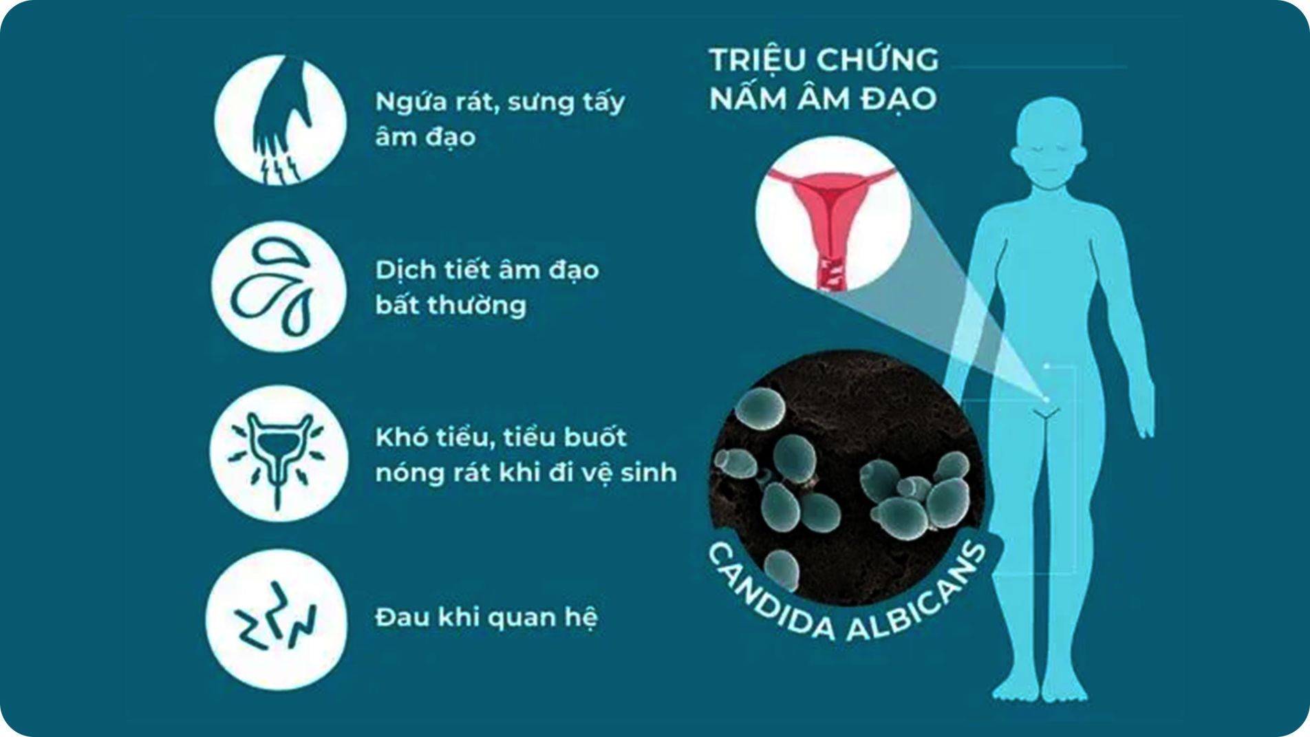Hình minh họa triệu chứng nấm âm đạo với khí hư trắng vón cục và viêm đỏ âm hộ
