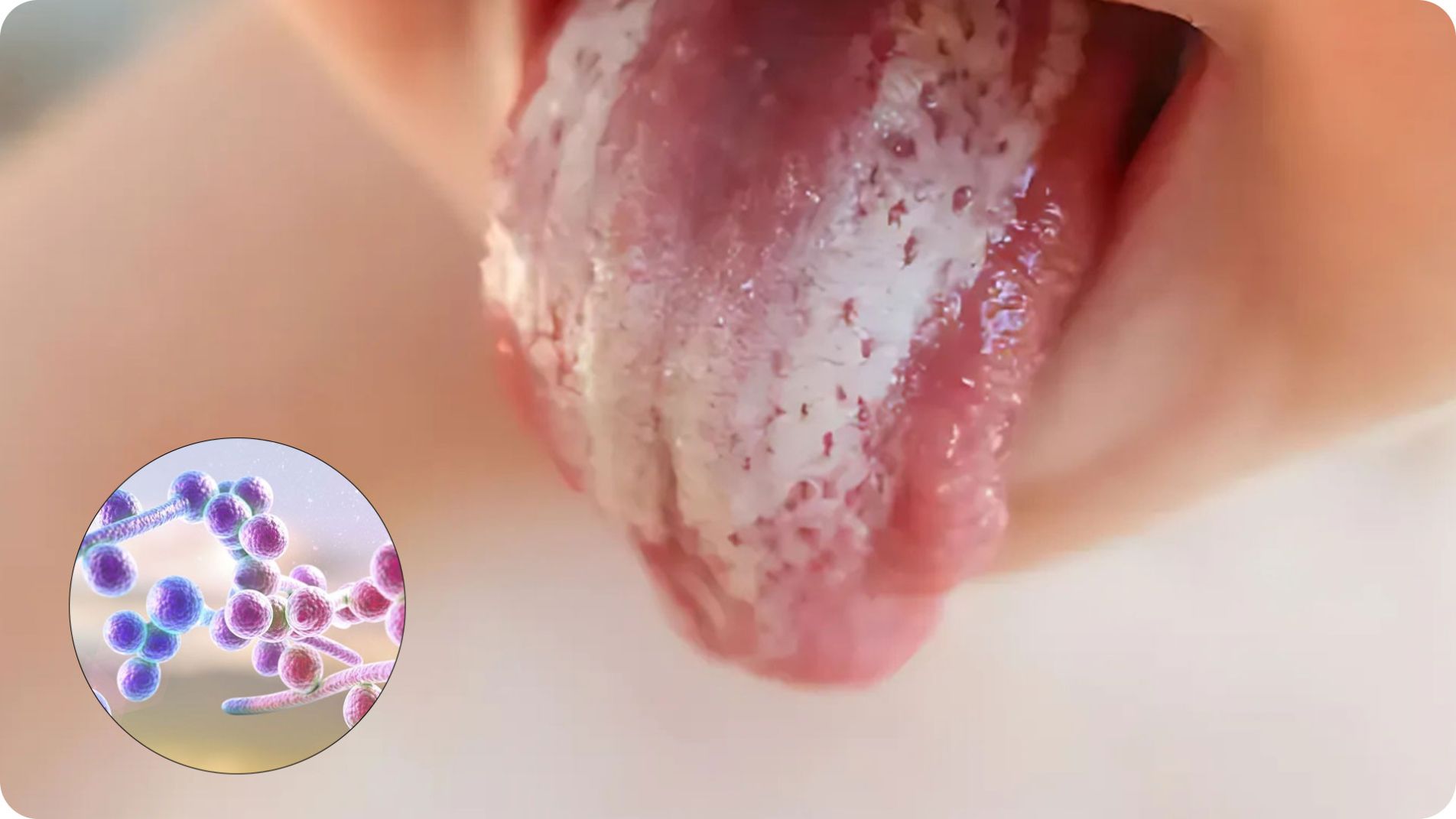 Triệu chứng mảng trắng nấm lưỡi (tưa lưỡi) ở trẻ em