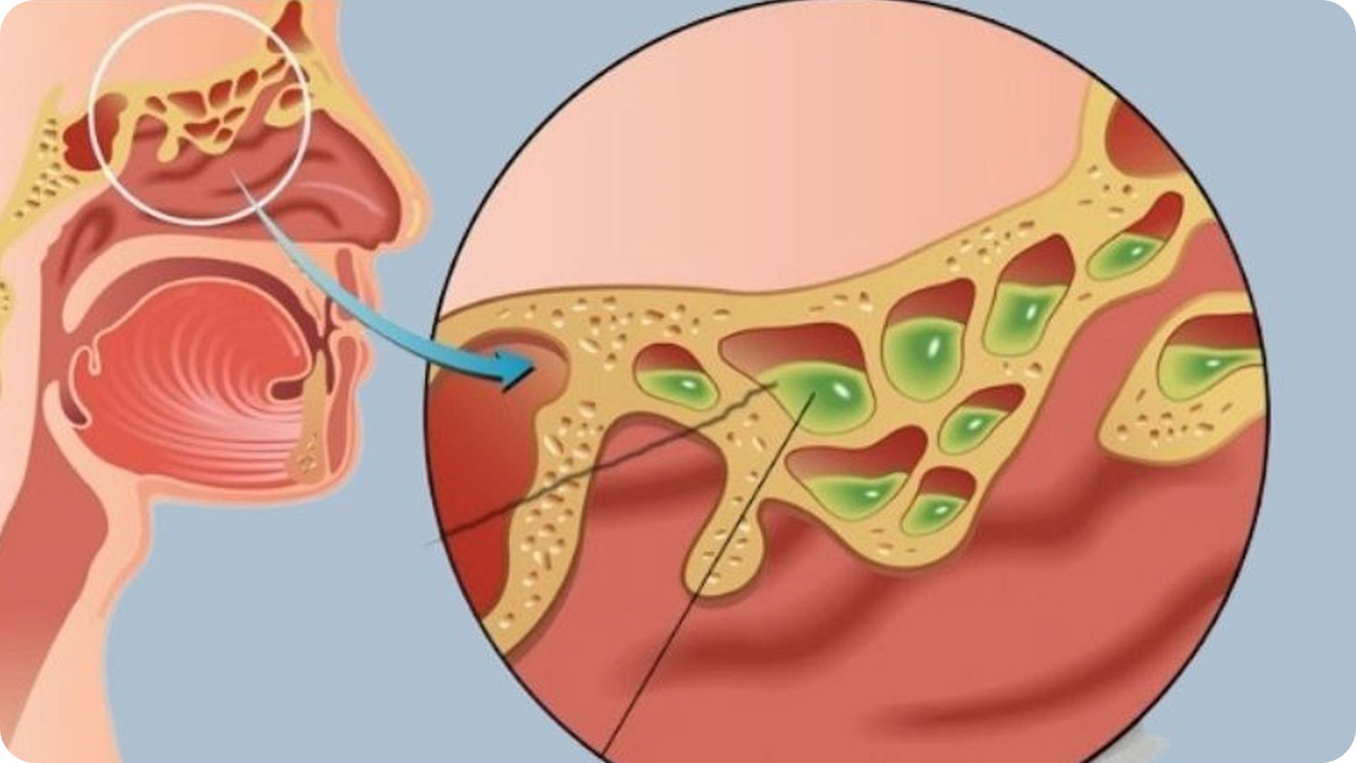 Chảy nước mũi (trong hoặc đục), dịch chảy xuống họng (postnasal drip)