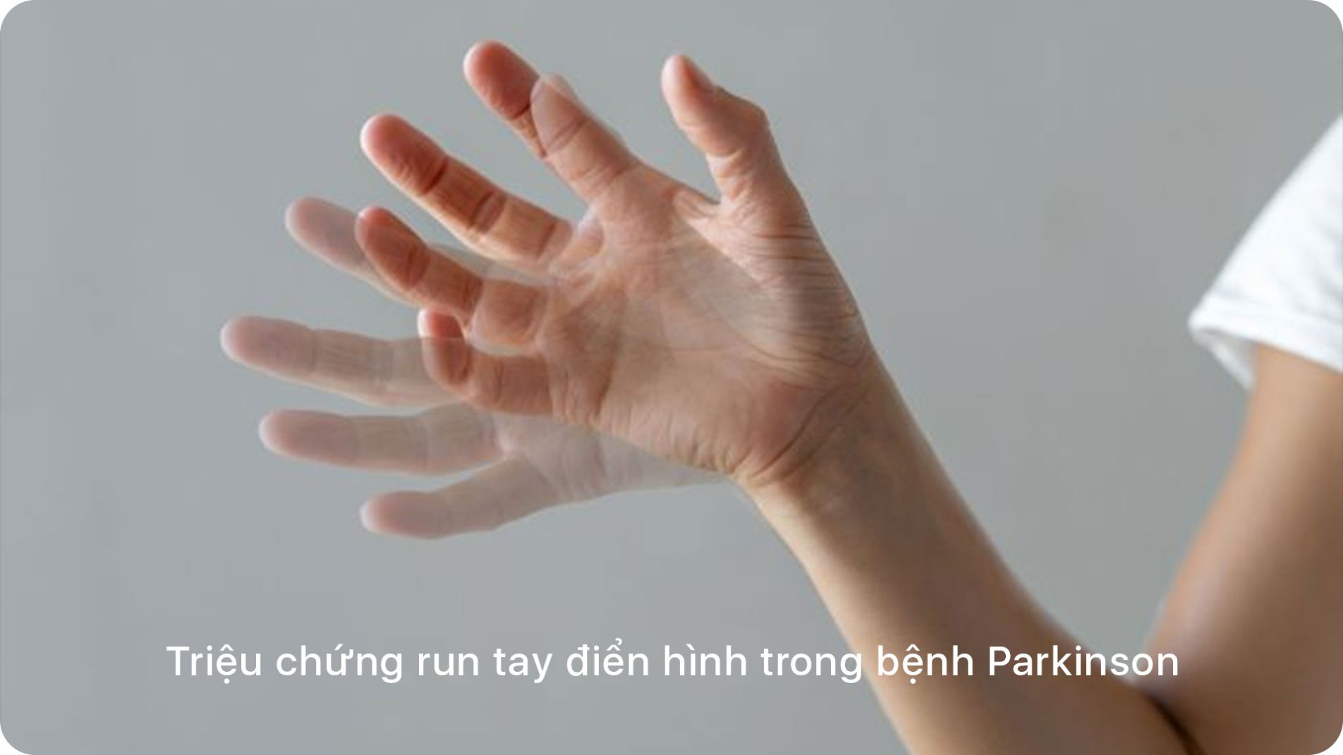 Triệu chứng run tay điển hình trong bệnh Parkinson