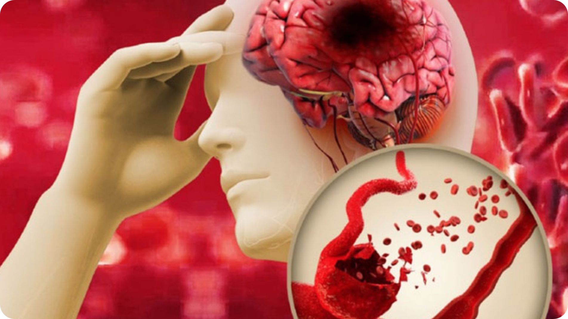 Nguyên nhân thiếu máu não do xơ vữa động mạch.