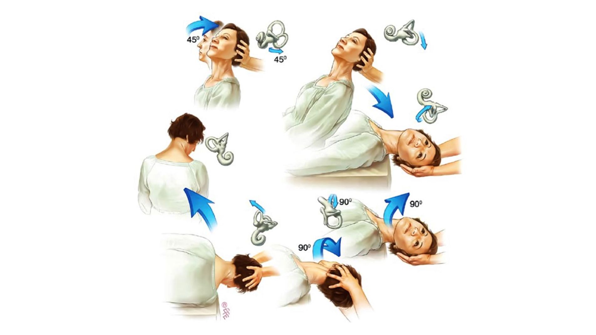 Bài tập phục hồi cho rối loạn tiền đình.