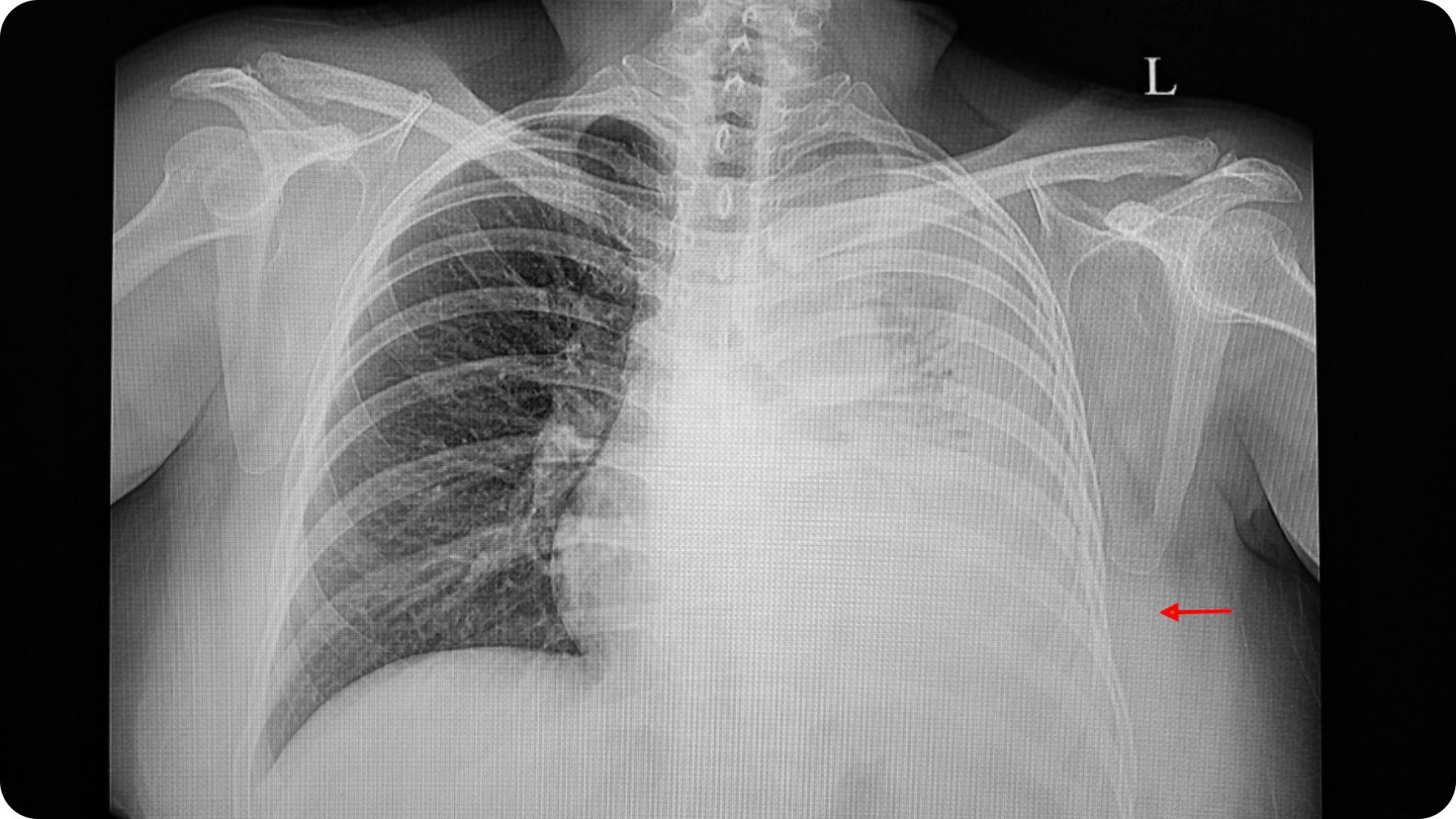 Hình ảnh X-quang ngực hiển thị tình trạng tràn dịch màng phổi một bên