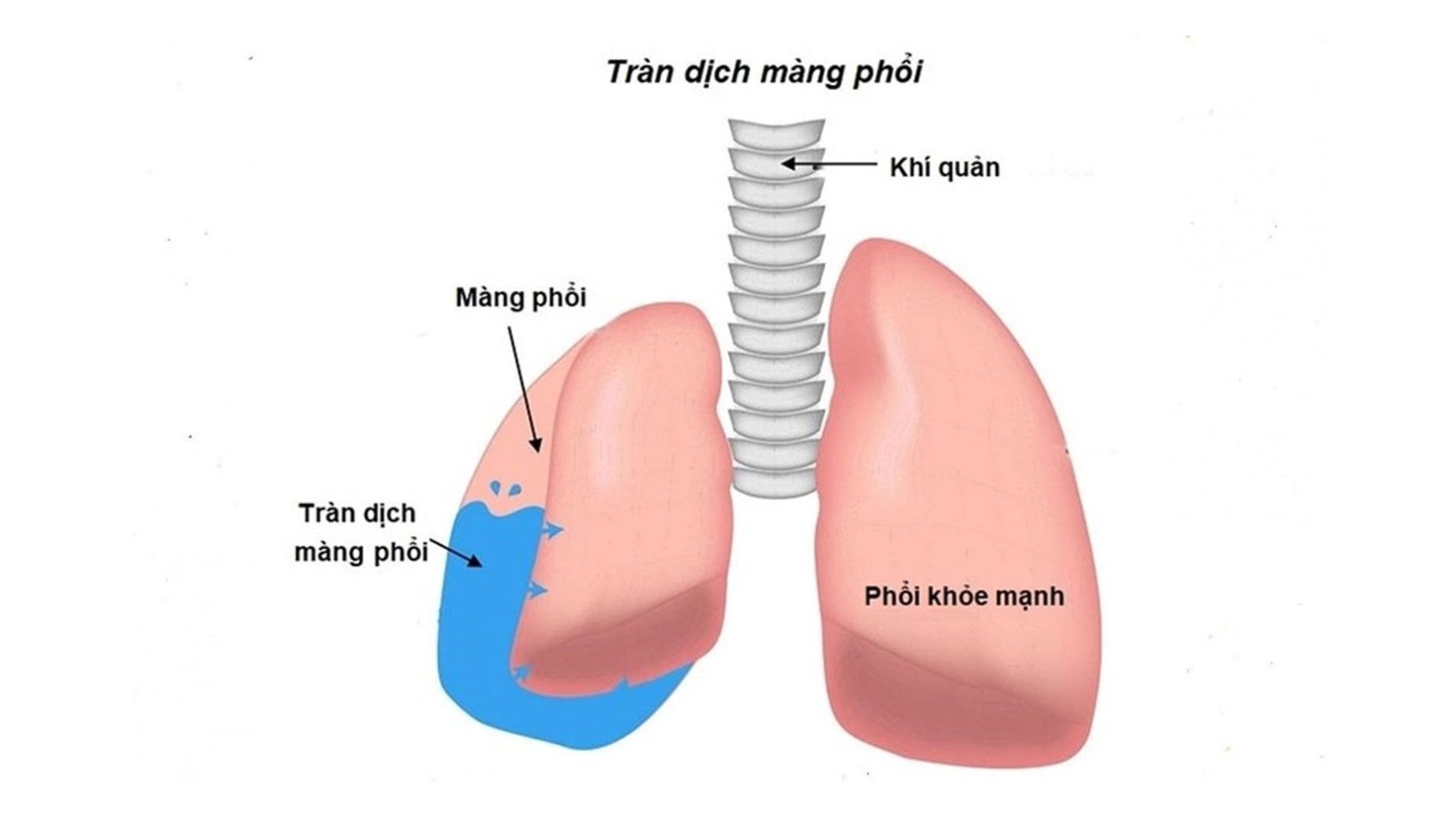 Sơ đồ cơ chế tích tụ dịch trong khoang màng phổi gây chèn ép phổi