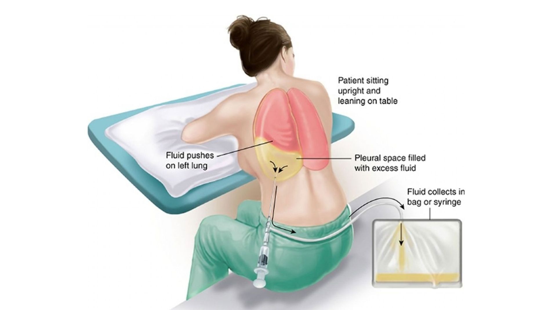 Thủ thuật chọc hút dẫn lưu dịch màng phổi an toàn dưới hướng dẫn siêu âm