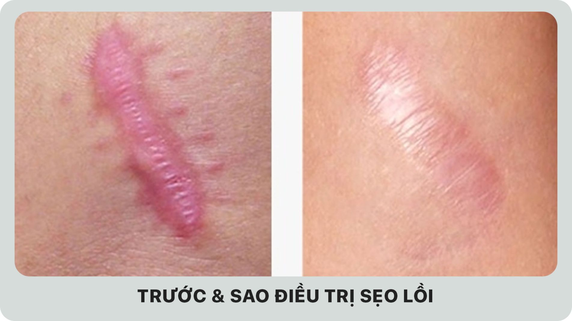 Kết quả laser xóa sẹo trên mặt trước và sau điều trị.