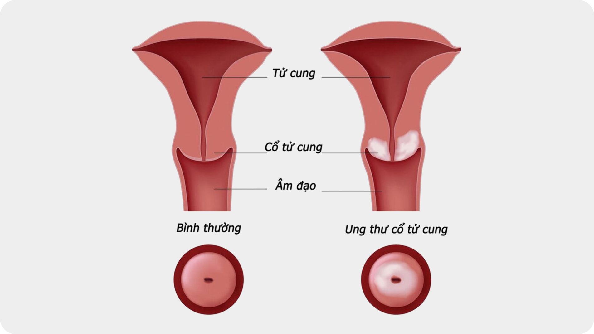 cổ tử cung bình thường và tổn thương ung thư cổ tử cung.