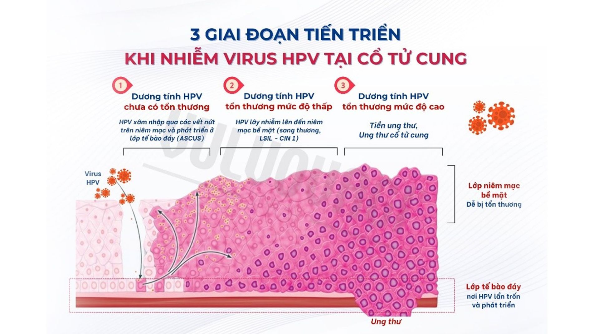 Sơ đồ cơ chế nhiễm HPV gây ung thư cổ tử cung.