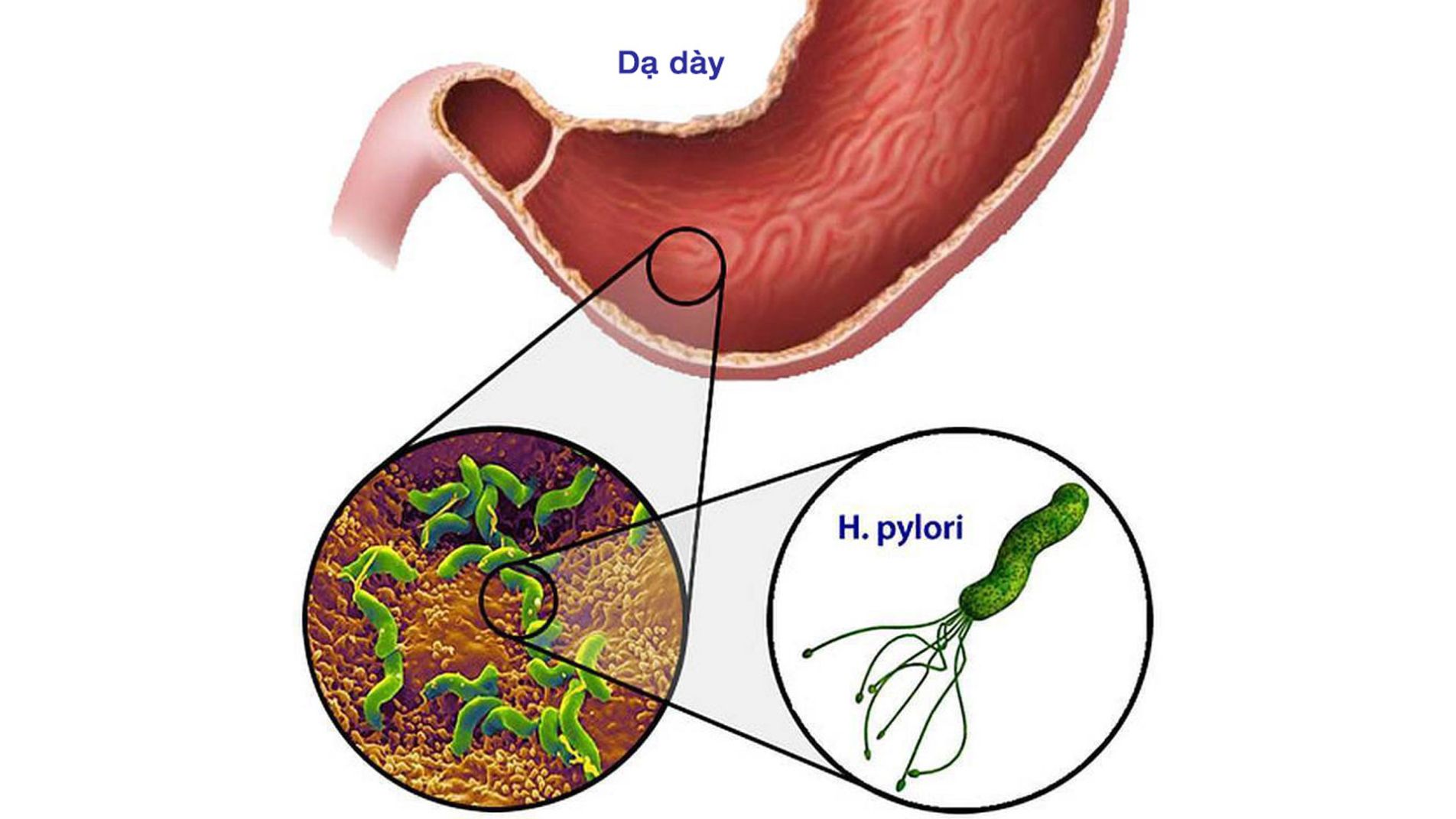 Hình ảnh nội soi vết loét dạ dày do vi khuẩn HP