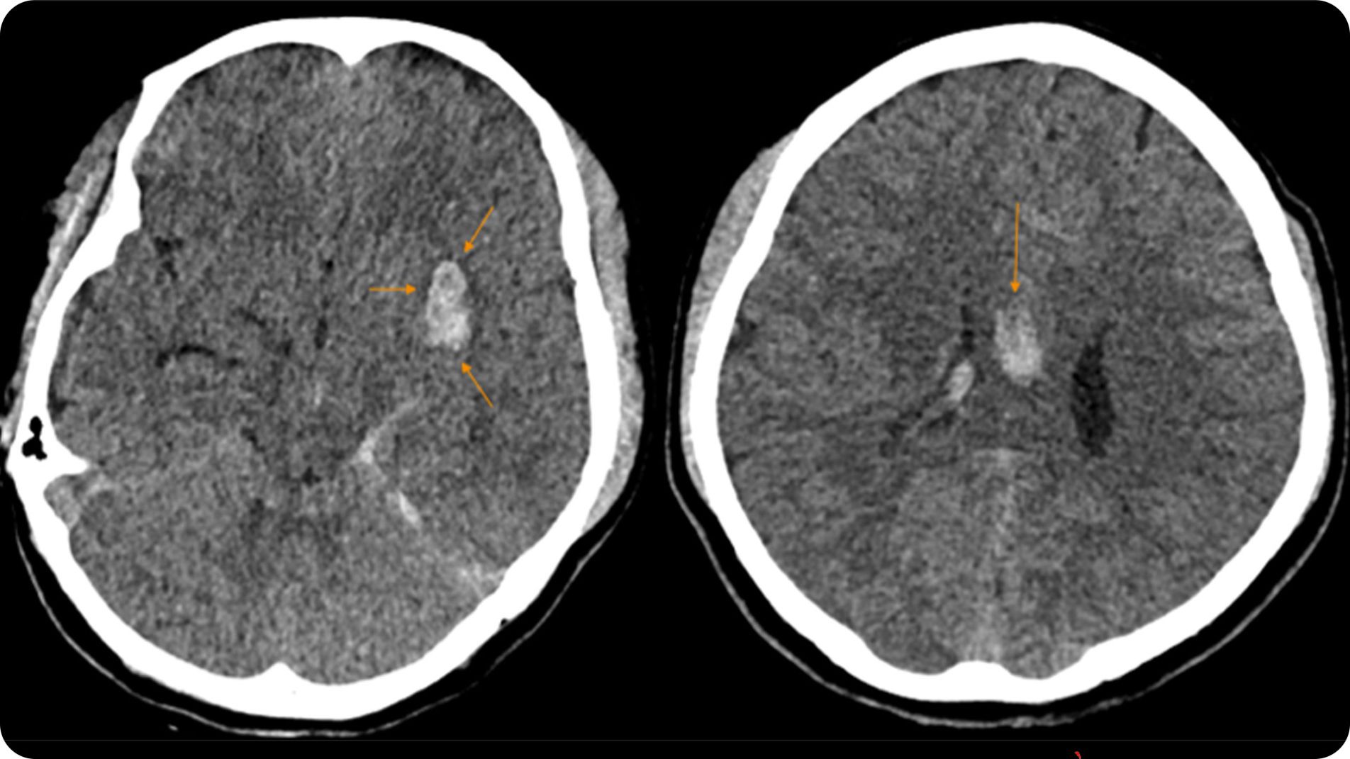 Hình ảnh CT scan não minh họa khối máu tụ trong xuất huyết não