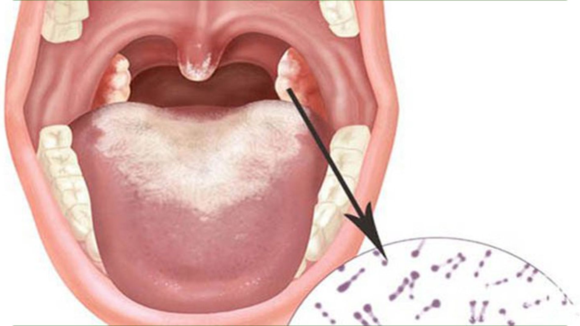 Ảnh minh họa giả mạc trắng xám bám chặt ở họng, amidan