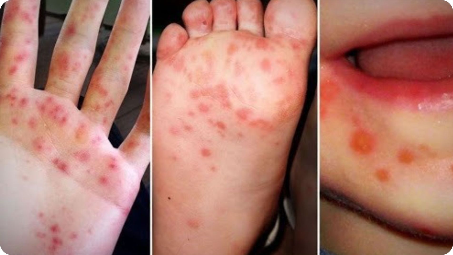 Phát ban đặc trưng tay chân miệng