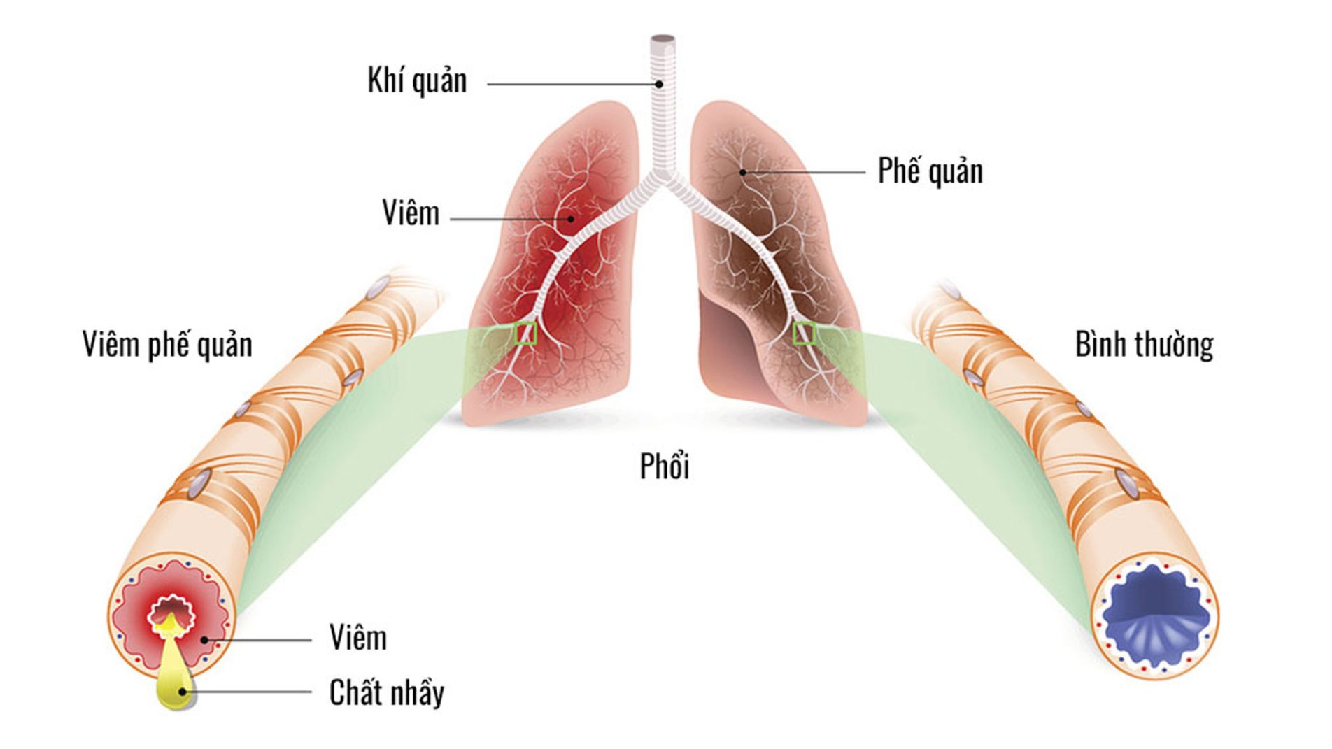 viêm phế quản cấp tính