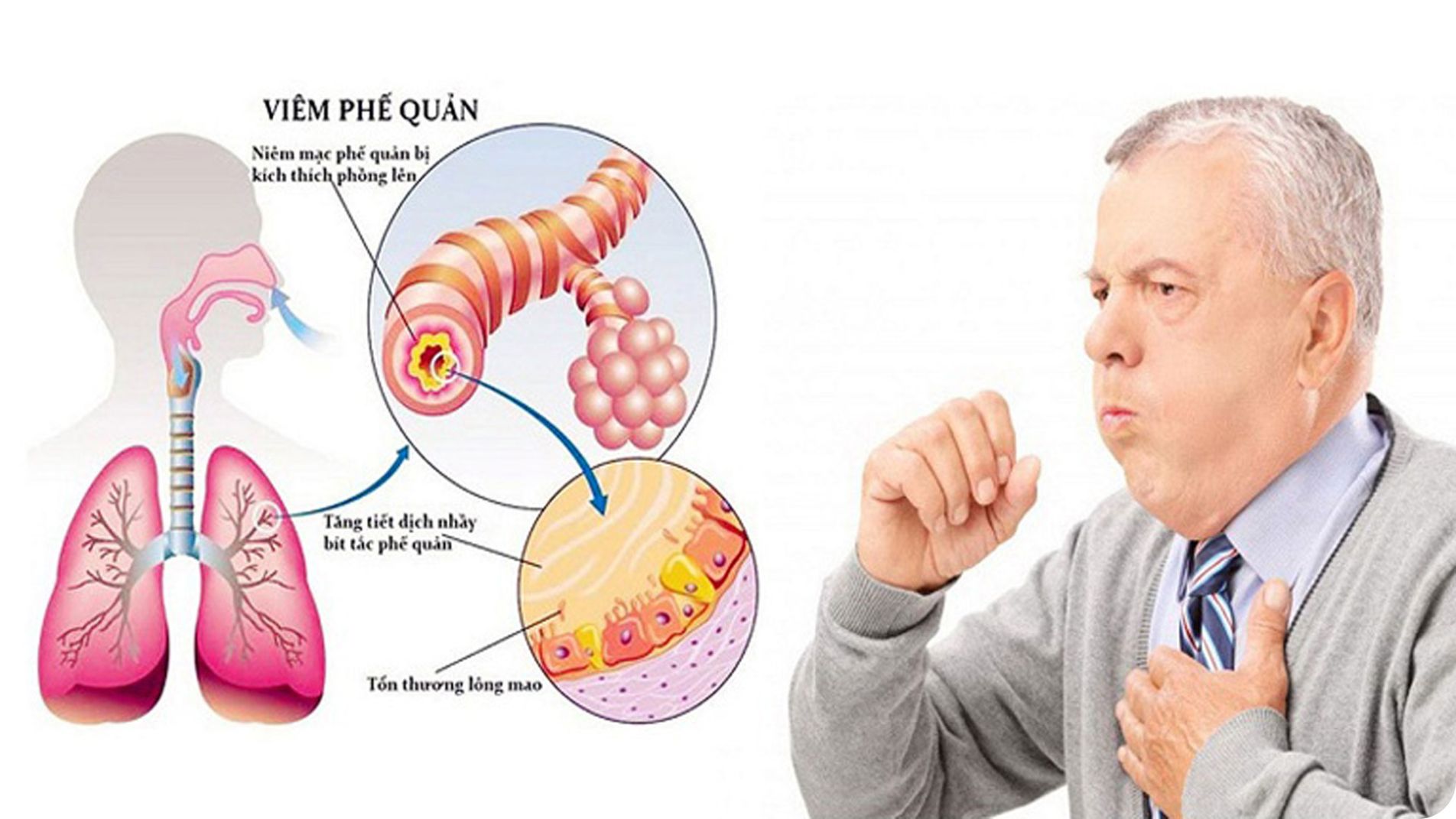Viêm phế quản cấp tính